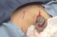 Video Pencet Jerawat Sebesar Bola Pimpong Jadi Viral