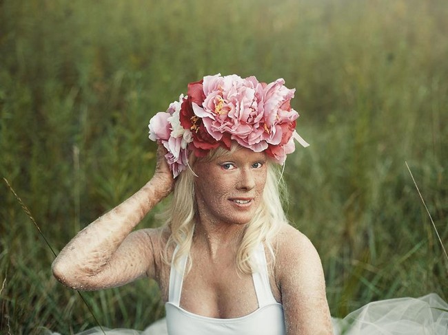 Bailey Pretak berhasil terpilih jadi Miss Pennsylvania dengan kondisi kulit tubuh dan wajah bersisik parah. Bailey mengidap lamellar ichtyosis. Kondisi genetik langka yang membuat kulitnya kering, pecah-pecah, hingga mengelupas. Penyakit yang menyerang satu dari 200.000 orang di dunia ini belum bisa disembuhkan. Karena kelainan tersebut, Bailey sempat ditindas dan dijuluki nama-nama kurang menyenangkan ketika kecil. Foto: Facebook Bailey Pretak