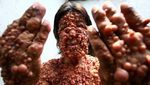 Menyedihkan! Potret Orang-orang dengan Tumor di Wajah Akibat Penyakit Langka