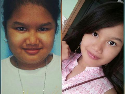 Kisah Anisa, Bocah Penyintas Autoimun Langka yang Inspiratif