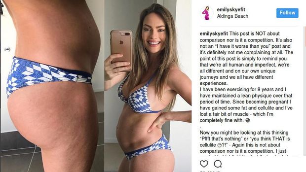 Muncul Selulit Saat Hamil, Wanita Ini Tetap <I>Pede</I> Narsis di Instagram