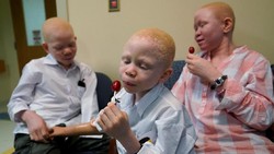 Anak-anak albino di Tanzania mengalami mutilasi karena tubuhnya dipercaya mengandung kekuatan sihir. Kini, mereka menggunakan prostetik di kesehariannya.
