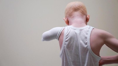 Potret Anak-anak Hantu Albino Asal Tanzania Korban Mutilasi