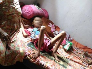 Dinkes Blitar Tak Banyak Bantu Akbar yang Sakit Leukemia