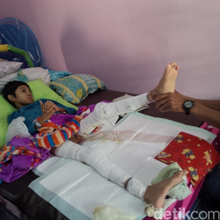 Bocah Helmi 5 Bulan Menahan Sakit Luka Bakar karena Tersambar Api Unggun