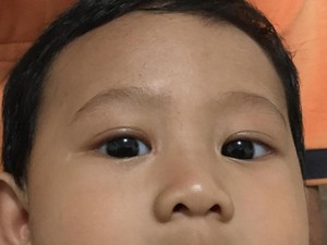 Mata Juling dan Menyala Saat Kena Sinar, Waspadai Retinoblastoma