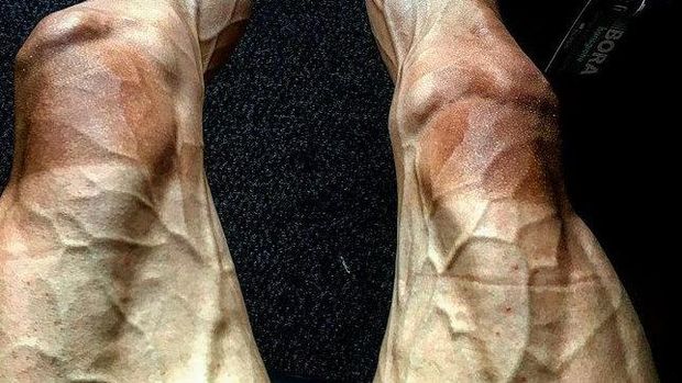 Penampakan kaki pebalap sepeda Pawel Poljanski yang berurat usai lomba