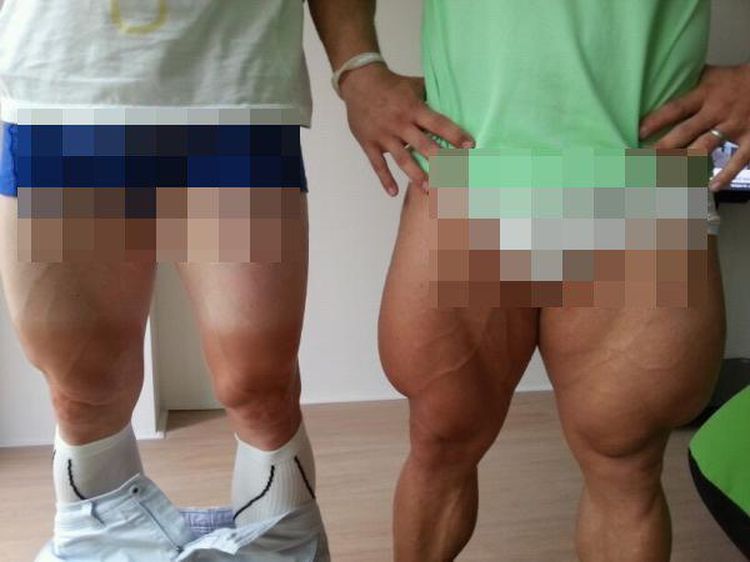Foto-foto Penampakan Kaki Berurat Akibat Olahraga Berat