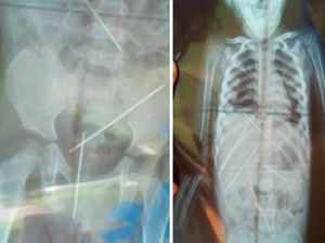 Bayi Ini Meninggal karena Infeksi, 7 Jarum Santet Bersarang di Tubuhnya