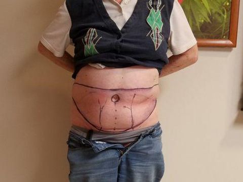 Bagian kulit perut Mary yang akan ditransplantasikan.