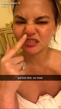 Chrissy Teigen Curhat Soal Kulit Berjerawat, Suarakan Hati Wanita PMS