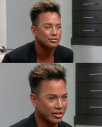 Obsesi Bibir Tebal, Jonathan Suntik Filler Sampai Mulutnya Susah Menutup
