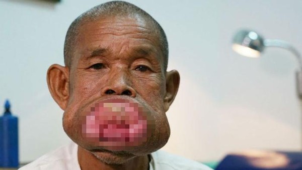 Tumor Penuhi Mulutnya, Begini Potret Kondisi Petani Miskin dari Vietnam