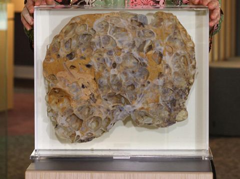 Berisi Cairan, Hati Wanita Ini Membesar 8 Kali Lipat di Atas Normal