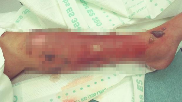 Kaki Bonita setelah terinfeksi bakteri pemakan daging