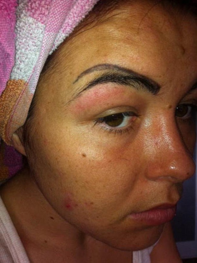 Alis wanita terbagi dua. Wanita ini syok dengan bentuk alisnya tersebut, hasil dari tato alis yang gagal.Foto: ist