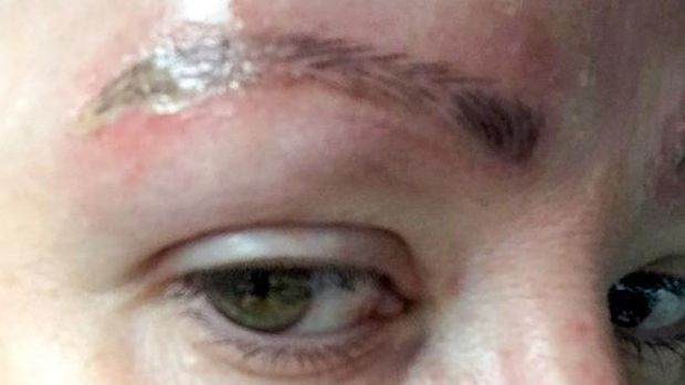 Ingin Alis Sempurna, Wanita Ini Malah Alami Hal Mengerikan 