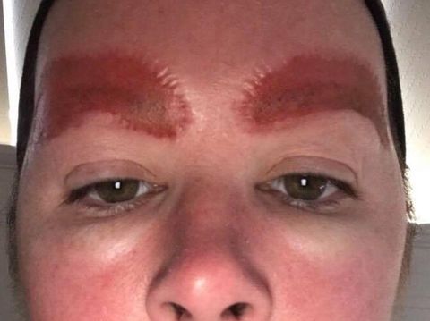 Ingin Alis Sempurna, Wanita Ini Malah Alami Hal Mengerikan 