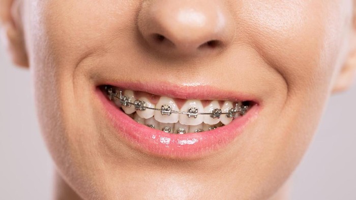 Healthy smile girl with braces