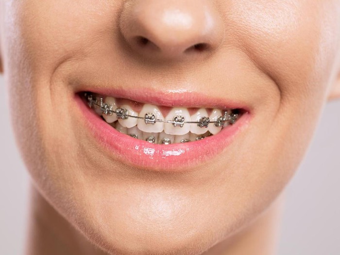 ilustrasi kawat gigi Healthy smile girl with braces