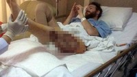 Ben Whiteside dan kekasihnya menikmati liburan jangka panjang di Yunnan, China. Pulang liburan, kaki Ben ternyata terinfeksi bakteri pemakan daging saat jatuh dan terluka. Meski harus kehilangan sebagian otot paha, kaki Ben masih bisa diselamatkan. (Foto: Facebook)
