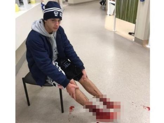 Diduga Diserang Kutu Laut, Kaki Remaja Australia Ini Penuh Luka