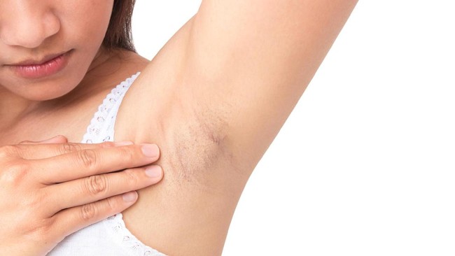 4 Penyebab Ketiak Menghitam