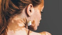 Vitiligo meski sekilas tampak mengerikan namun sebetulnya bukan penyakit berbahaya. Kondisi ini juga tidak menular. (Foto: Instagram/vitiligo.beauty)