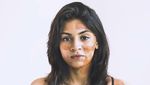 Foto Para Wanita Cantik dengan Kondisi Kulit Vitiligo