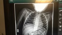 Foto rontgen bocah yang menelan kalung berbentuk hati. Setidaknya ia dipenuhi oleh cinta. (Foto: Instagram/manncura) 