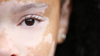Menurut dokter vitiligo yang terdiagnosa di usia tua lebih mudah disembuhkan dibanding vitiligo pada anak-anak. (Foto: Instagram/missoesbrasil_)