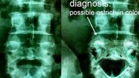 Ada yang aneh dengan struktur tulang pasien ini? Ya, Bentuknya mirip burung onta. (Foto: Instagram/radiologic_technologist) 