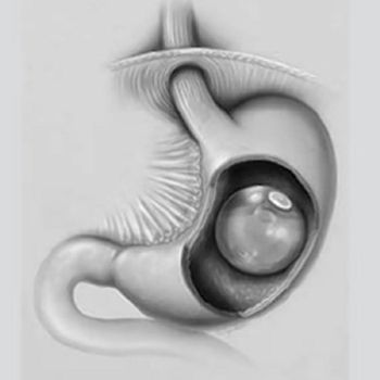 5 Pasien Obesitas Meninggal Usai Pasang Balon di Lambung