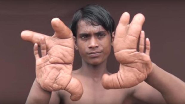 Tangan Tarik membesar hingga 30 cm