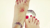Luka lecet di punggung kaki karena bergesekan dengan high heels. (Foto: Instagram/lisahouck)