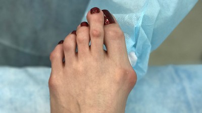 Ouch!! Foto-foto Ini Buktikan High Heels Tidak Baik untuk Kesehatan Kaki