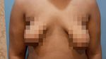 Foto: Gynaecomastia, Ketika Payudara Pria Tumbuh Seperti Wanita