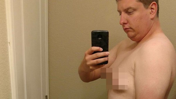 Foto: Gynaecomastia, Ketika Payudara Pria Tumbuh Seperti Wanita