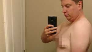 Foto: Gynaecomastia, Ketika Payudara Pria Tumbuh Seperti Wanita