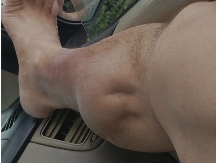 Ngeri!! Otot Kaki Pria Ini Kram Seperti Kemasukan Mahluk Hidup