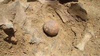 Ini kemungkinan batu ginjal tertua yang pernah ditemukan peneliti di pemakaman prasejarah di daerah Sudan. Berukuran sebesar kacang walnut, usia batu ginjal ini sekitar 12 ribu tahun. (Foto: Universita di Padova)