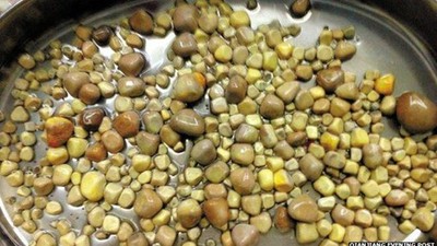 Foto: Kasus-kasus Unik Batu Ginjal: Ada yang Ribuan Hingga Sebesar Kelapa