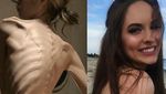 Foto Transformasi Para Wanita Anoreksia: Dari Kurus Kering Kembali Berisi