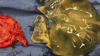 Ini adalah contoh implan gagal yang diambil dari payudara seorang pasien wanita. Implan pecah mengeluarkan silikon di sekitar payudara dan menyebabkan komplikasi pada sang pasien. (Foto: Instagram/breast_implant_illness)