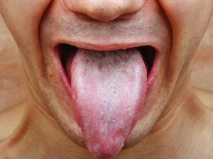 Angka Harapan Hidup Masih Singkat, Kini Kanker Mulut Serang Usia Muda