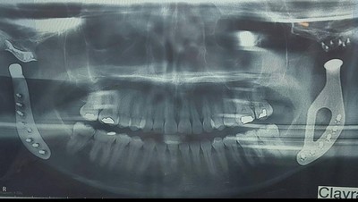 Foto-foto Perjuangan Wanita dengan Rahang dari Titanium