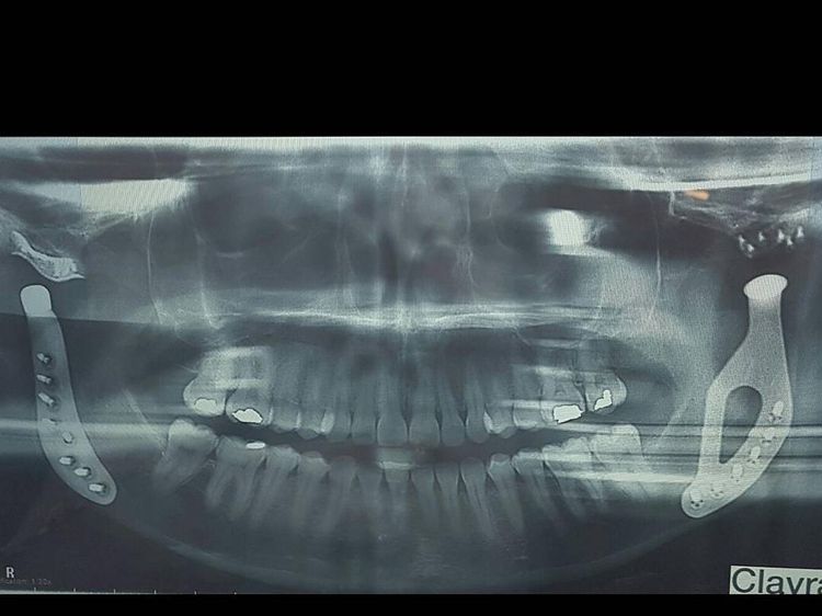 Foto-foto Perjuangan Wanita dengan Rahang dari Titanium