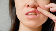 Gejala Awal Kanker Mulut yang Perlu Bunda Tahu