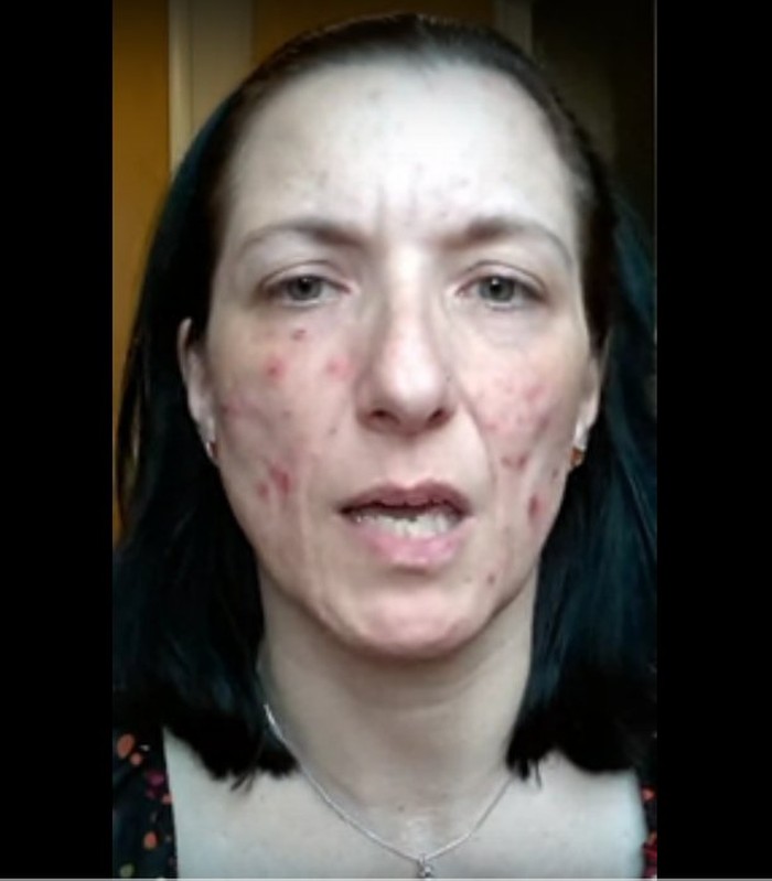 Idap Dermatillomania, Wanita Ini Selalu Ingin Menguliti Kulitnya