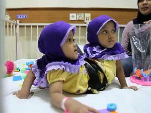 Kaki Tambahan Balita Kembar Siam Asal Garut Berhasil Dihilangkan